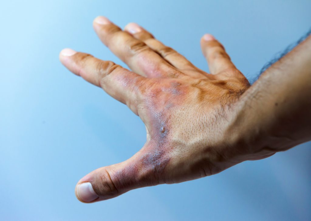 eerstegraads brandwond op de hand van een man