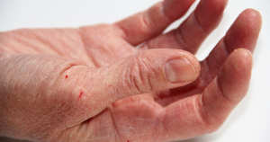 Een voorbeeld van kloven in de vingers bij een uitgedroogde huid.