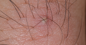 Ingegroeide haartjes kunnen roodheid, irritatie en een ontstoken haarzakje veroorzaken.