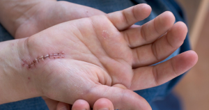 Littekencreme kind: voorbeeld van een gehechte wond bij een kind dat een litteken zal achterlaten. 