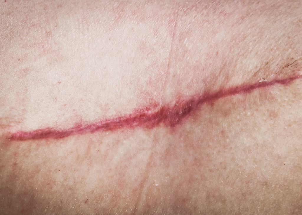 rood litteken verminderen