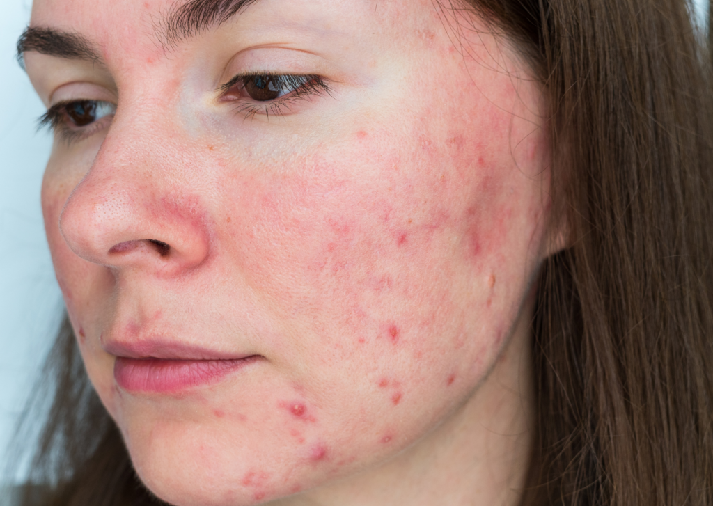 rosacea natuurlijk behandelen