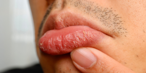 Bij schrale lippen kunnen droge velletjes, barstjes en kloofjes ontstaan. Probeer niet aan losse velletjes te trekken, omdat je de kwetsbare huid hierdoor verder kunt beschadigen.
