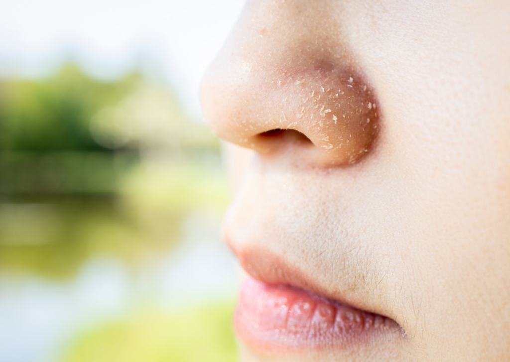 Schilferige huid gezicht