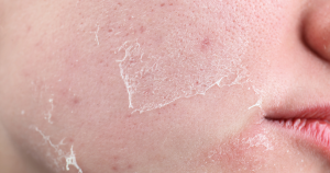 Droge velletjes en schilfers ontstaan vaak door een verstoorde huidbarrière.