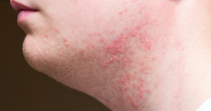 geirriteerde huid na scheren: typische klachten na het scheren: roodheid, irritatie, bultjes, ingegroeide haartjes.