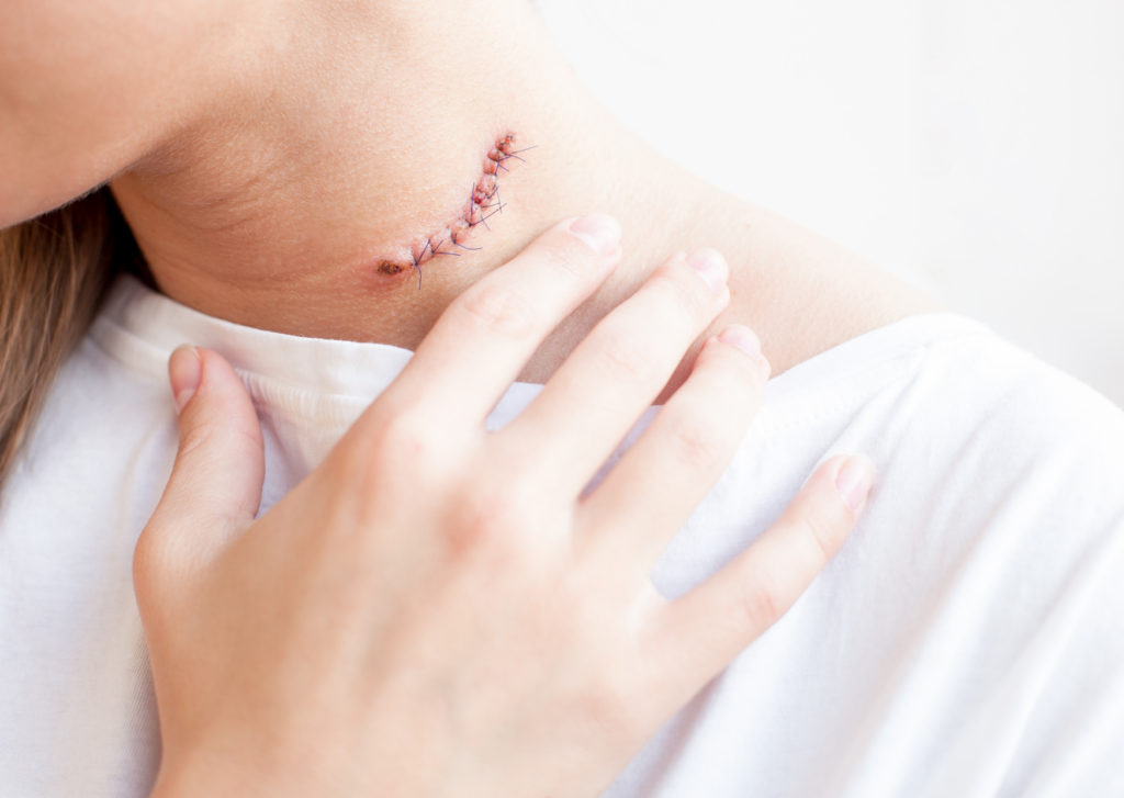 littekenweefsel na operatie