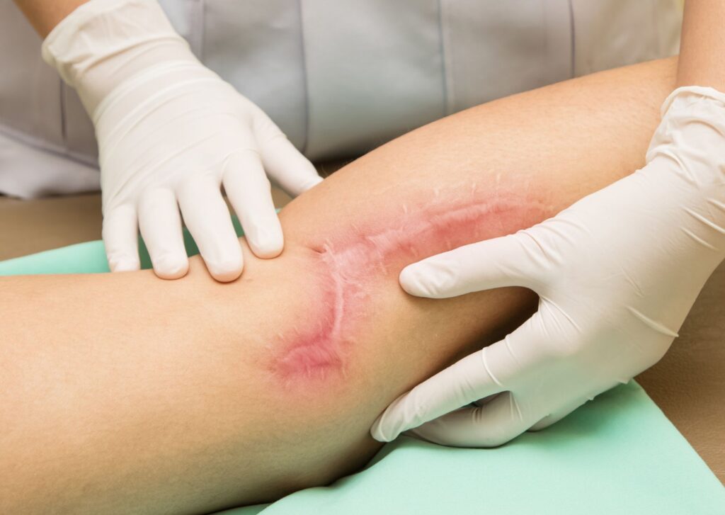 ontstoken litteken na operatie