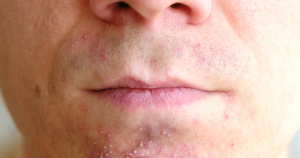 Door verstopte poriën, kan er een ontsteking ontstaan. Daardoor ontstaan bijvoorbeeld puistjes op de kin.