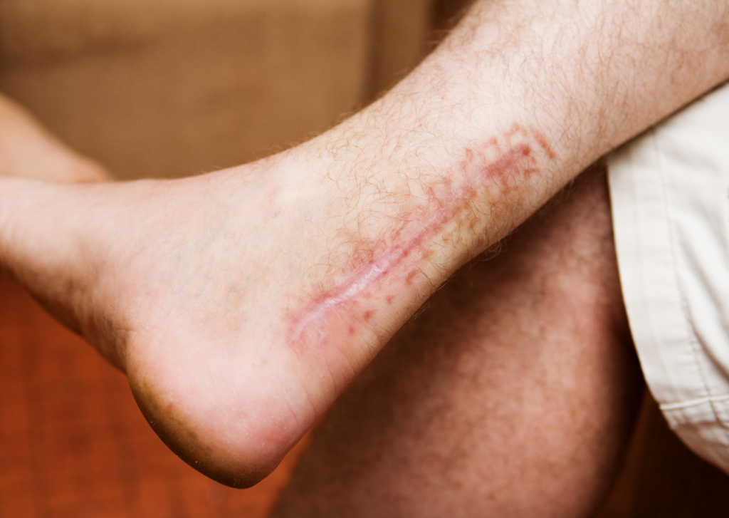 zalf voor littekens na operatie