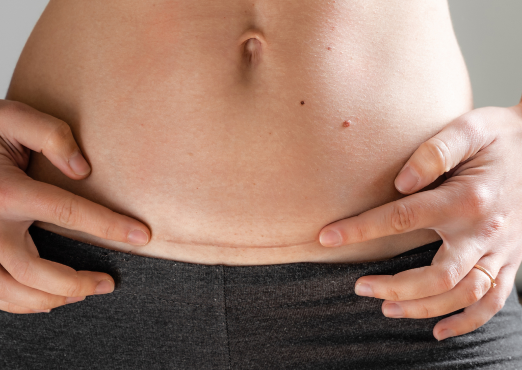 litteken soepel maken