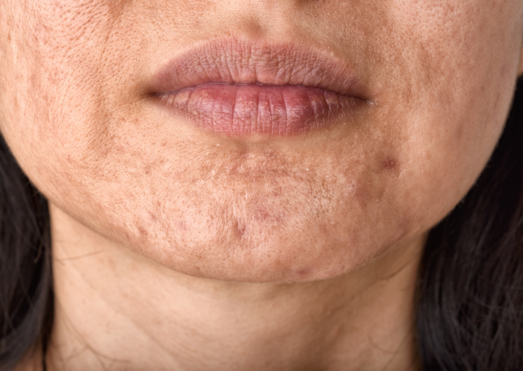 littekencrème gezicht