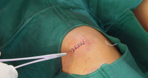 Wanneer het voor het lichaam lastiger wordt om de wond te sluiten kiest een arts er vaak voor om de wond te hechten.