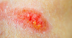 Een close-up van een schaafwond.