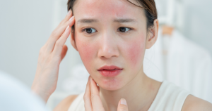 Een verstoorde huidbarrière speelt vaak een rol bij een branderige huid in het gezicht.