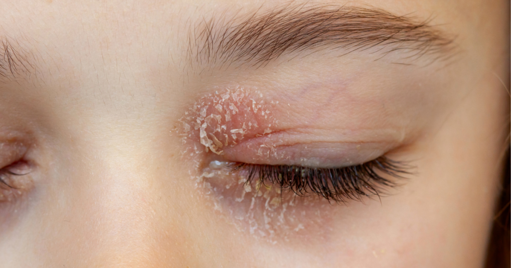 Droge oogleden kunnen voor verschillende klachten zorgen, zoals schilfers