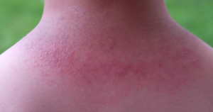 Hitte puistjes op de rug van een kind.