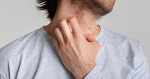Stressvlekken: Stressvlekken kunnen roodheid, jeuk en bultjes veroorzaken, vooral op de hals en het gezicht tijdens stressvolle periodes.