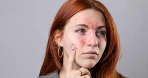 Roodheid in het gezicht kan komen door huidaandoeningen zoals rosacea.