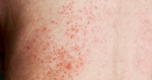 Hier een voorbeeld van iemand met de zweetuitslag variant miliaria rubra.