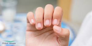 Gezonde nagelriemen sluiten mooi aan rondom de nagels en helpen de kwetsbare huid bij de nagelbasis te beschermen.