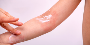 Dagelijkse huidverzorging met een vette zalf of crème helpt de huidbarrière te ondersteunen en vormt een belangrijk onderdeel van de behandeling van dermatitis.