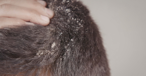 Seborroïsch eczeem komt vaak voor op de hoofdhuid en is dan zichtbaar als roos.