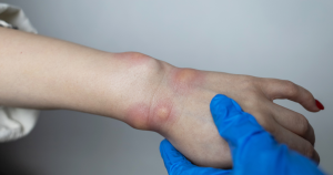 Beste zalf tegen insectenbeten: in sommige gevallen krijgen mensen heftige allergische reacties van insectenbeten