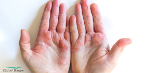Bij handeczeem kan de huid droog, rood en geïrriteerd raken. Handschoenen helpen de gevoelige huid te beschermen tegen irriterende invloeden van buitenaf.