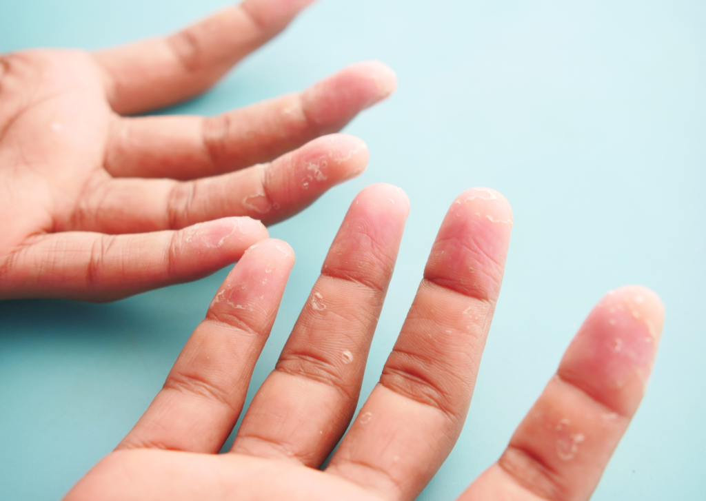eczeem handen blaasjes
