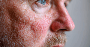 Rosacea is een veelvoorkomende huidaandoening die roodheid in het gezicht veroorzaakt