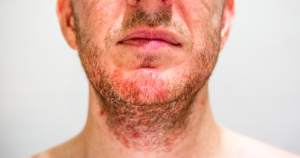 Seborroïsch eczeem natuurlijke behandeling: Seborroïsch eczeem in de baardregio met roodheid en schilfering.