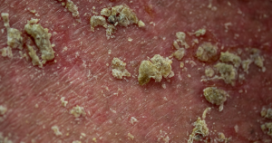 Seborroïsch eczeem natuurlijke behandeling: Detailopname van seborroïsch eczeem bij een man.