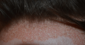 Huidaandoeningen zoals eczeem en psoriasis kunnen een jeukend voorhoofd veroorzaken