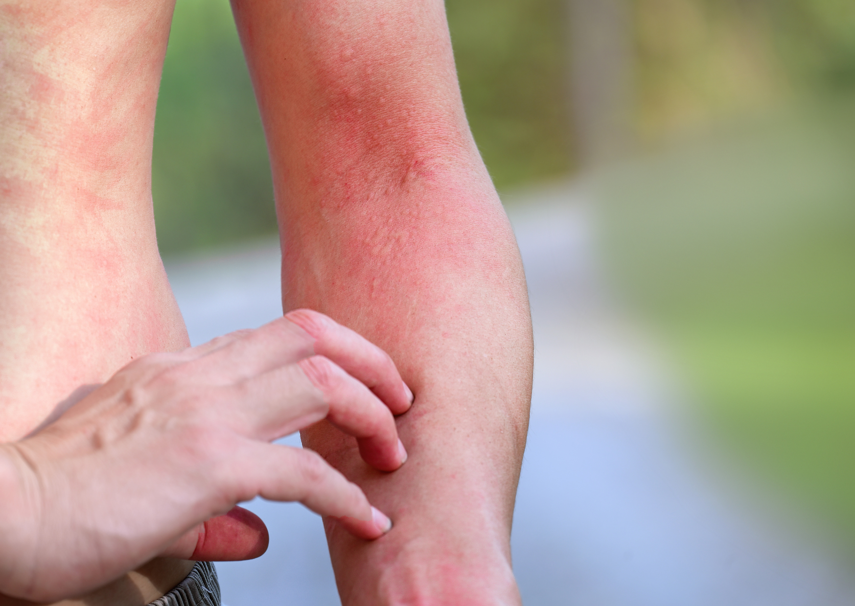allergische reactie huid jeuk
