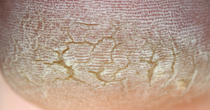 Diepe kloven in de voet herken je aan zichtbare, diepere scheuren in de huid.