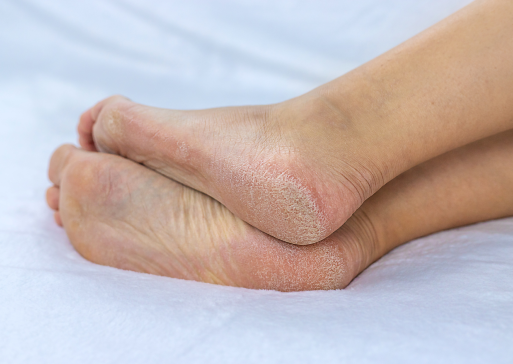 diepe kloven in voet