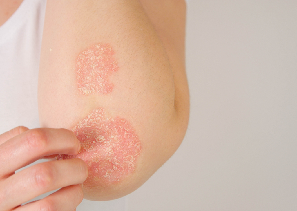 droge ruwe plekjes op huid