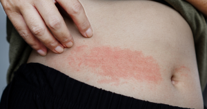 Droge rode vlekken op de huid kunnen verschillende oorzaken hebben. Daarom is het belangrijk om niet alleen naar de vlek zelf te kijken, maar ook naar andere klachten zoals jeuk, schilfering en irritatie.