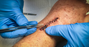 Litteken verzorgen na hechting: zodra de wond volledig gesloten is en de hechtingen minimaal een week verwijderd zijn kan je starten met littekenverzorging