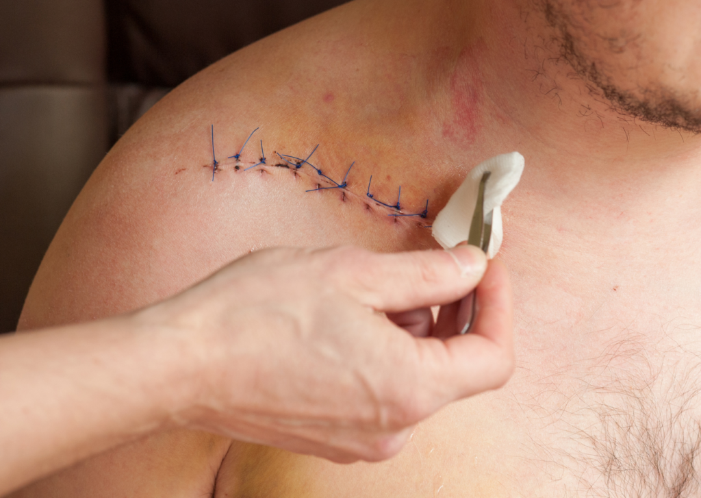 litteken verzorgen na hechting