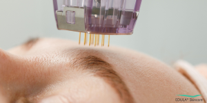Hier zou ik zetten:Bij microneedling maken fijne naaldjes gecontroleerde microkanaaltjes in de huid om het natuurlijke herstelproces te activeren.