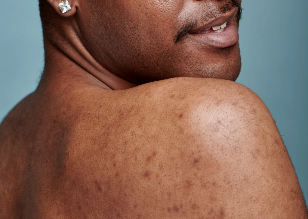 hyperpigmentatie behandelen