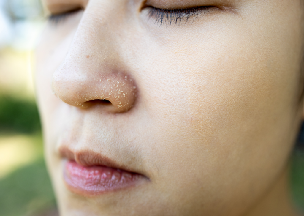 schilfers neusvleugels