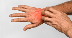 Blaasjeseczeem zorgt voor diverse klachten zoals: jeuk, pijn en branderigheid.