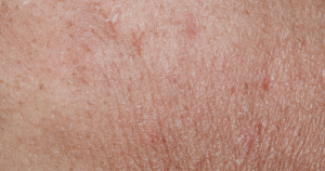 Een close-up van een schrale huid.