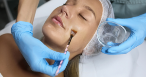 Een chemische peeling stimuleert de natuurlijke huidvernieuwing en kan helpen bij onder andere pigmentvlekken, acne, fijne lijntjes en een doffe huid.