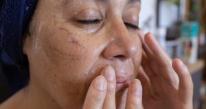 Na een chemische peeling kan de huid tijdelijk rood worden en ook gaan schilferen. Dit hoort meestal bij het natuurlijke vernieuwingsproces van de huid.