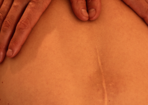 Littekenweefsel masseren: Massage ondersteunt namelijk het natuurlijke herstel en verhelpt zo pijn en trekkerigheid te verminderen