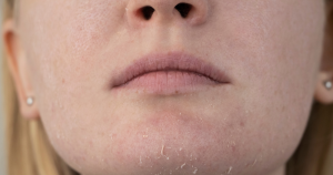 Een droge huid zal vaak eerder branderig aanvoelen. 